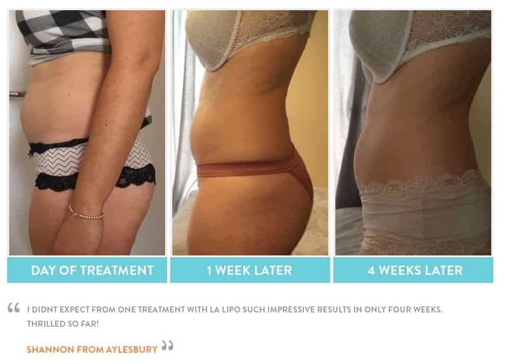 before, Cryolipolysis Barnes