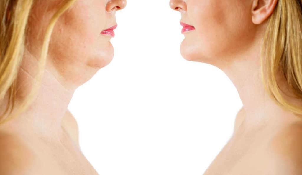 Double Chin treatment Barnes before and after results