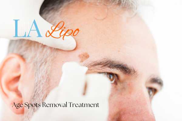 What Are the Most Effective Treatments for Age Spots Barnes?