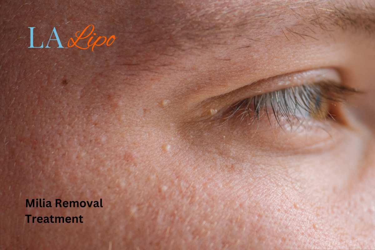 Cryopen Milia Removal: Is It the Easiest and Safest Option Barnes?