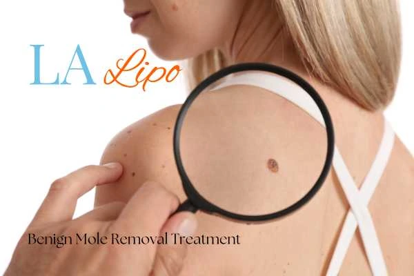 Woman having her inspection of blemish before mole removal Barnes