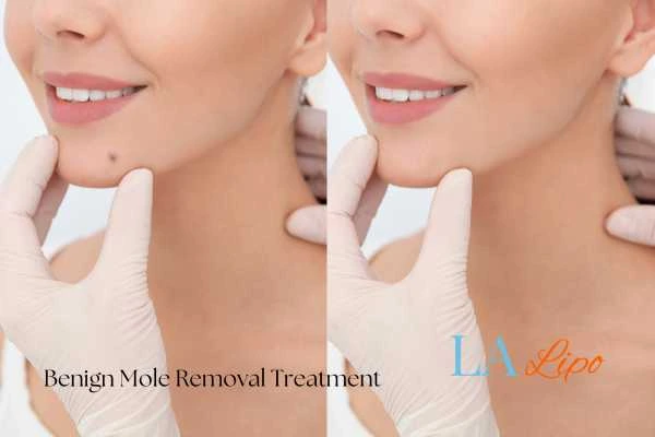woman's before and after mole removal Barnes results