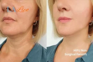 hi-fu for wrinkles Barnes before and after results
