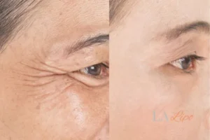 Before and after results of woman - HI-fu wrinkles reduction treatment Barnes