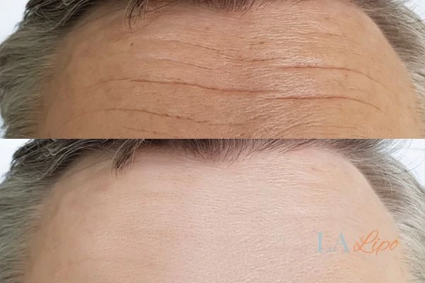 results of HIFU Barnes on mans forehead to help reduce lines and wrinkles