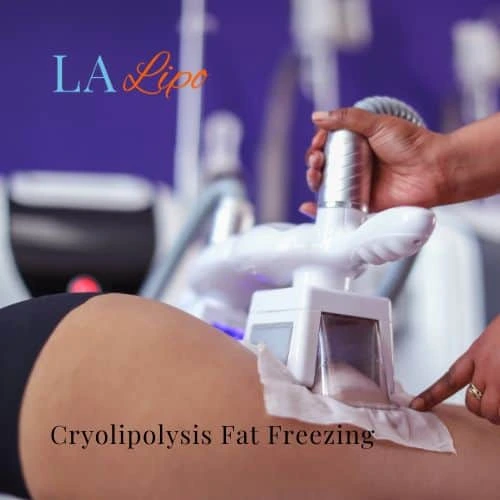 fat freezing - Cryolipolysis Barnes