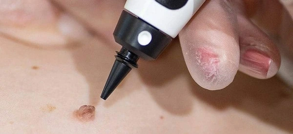 skin tag removal using cryopen Barnes
