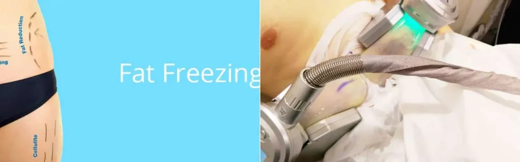 multi areas of a persons body having coolsculpting Barnes treatment