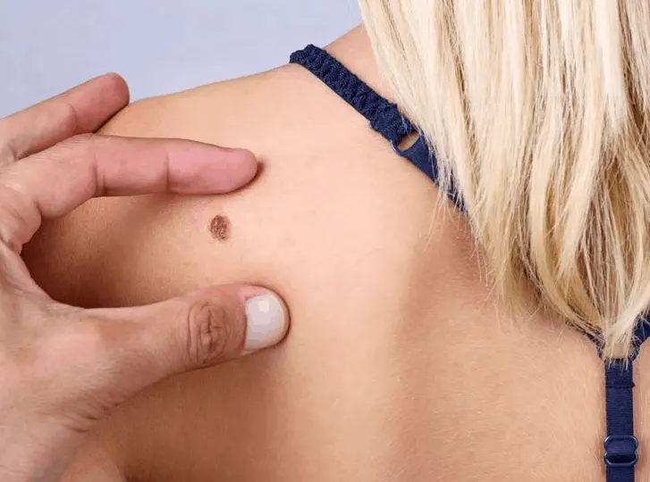 woman having mole removal Barnes consultation before treatment.