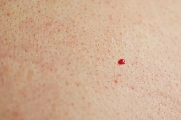 close up of a cherry angioma Barnes
