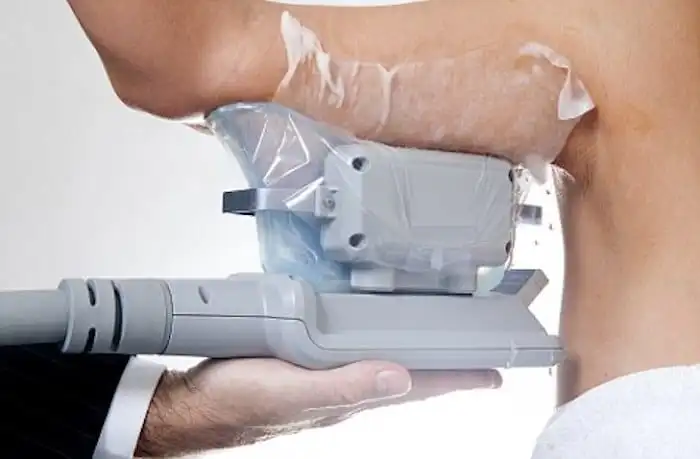 Picture of fat freezing Barnes on the upper arms.