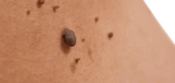 image of a skin tag Barnes