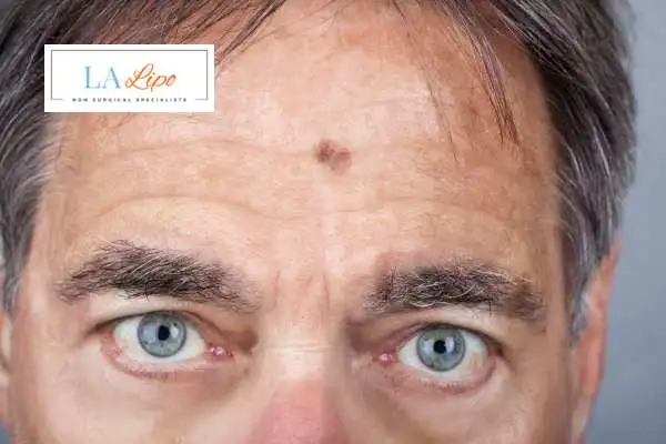 Solar Lentigo Removal Barnes image of man with mark on his forehead