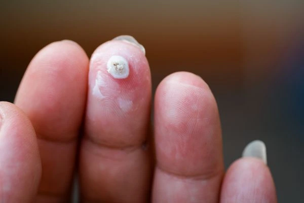 wart on person finger - cryotherapy to treat from LA LIPO Barnes