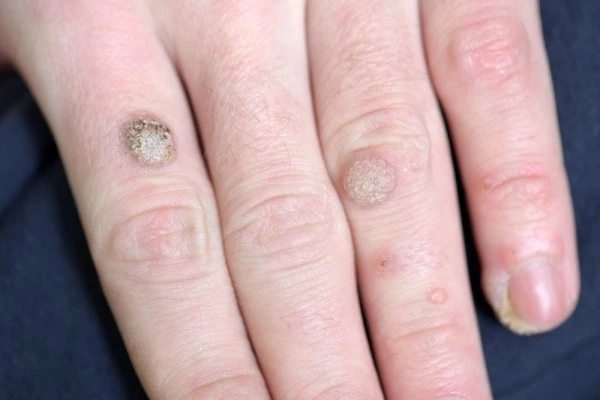 photo of warts on person hand - see wart removal Barnes from LA LIPO
