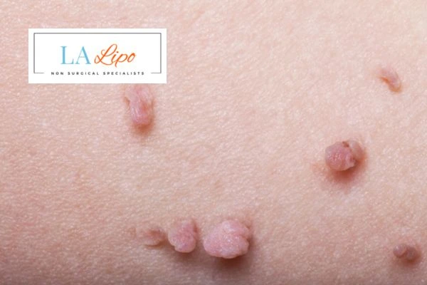 Does cryopen skin tag removal Barnes hurt? Find out now call our team today!