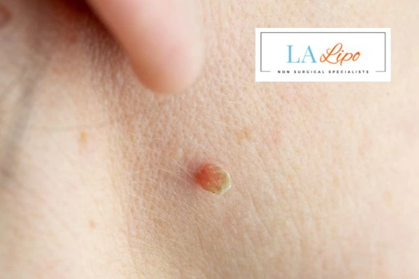 Book skin tag removal Barnes today speak to our team now!