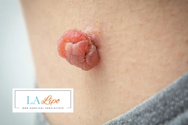 Interested in skin tag removal Barnes? Concerned about the pain? Find out more today!
