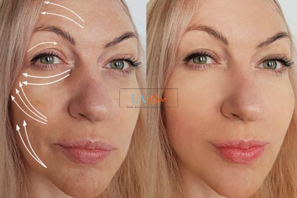 Morpheus 8 results Barnes face lift.
