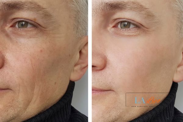 See the amazing results of Morpheus8 Treatment Barnes!