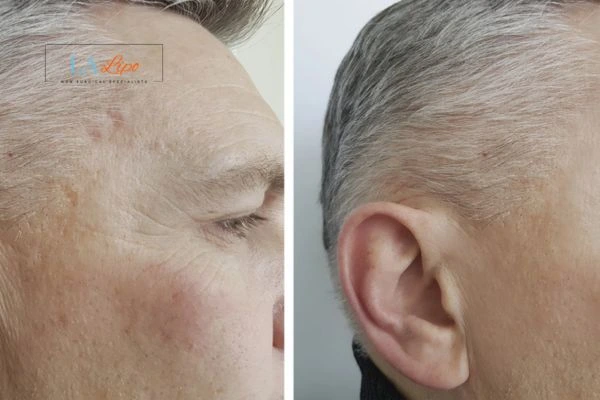 Mens Before & After Morpheus 8 Results Barnes