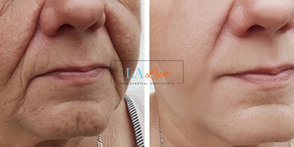 Older lady deeper wrinkle reduction - LA LIPO Morpheus 8 Results Barnes