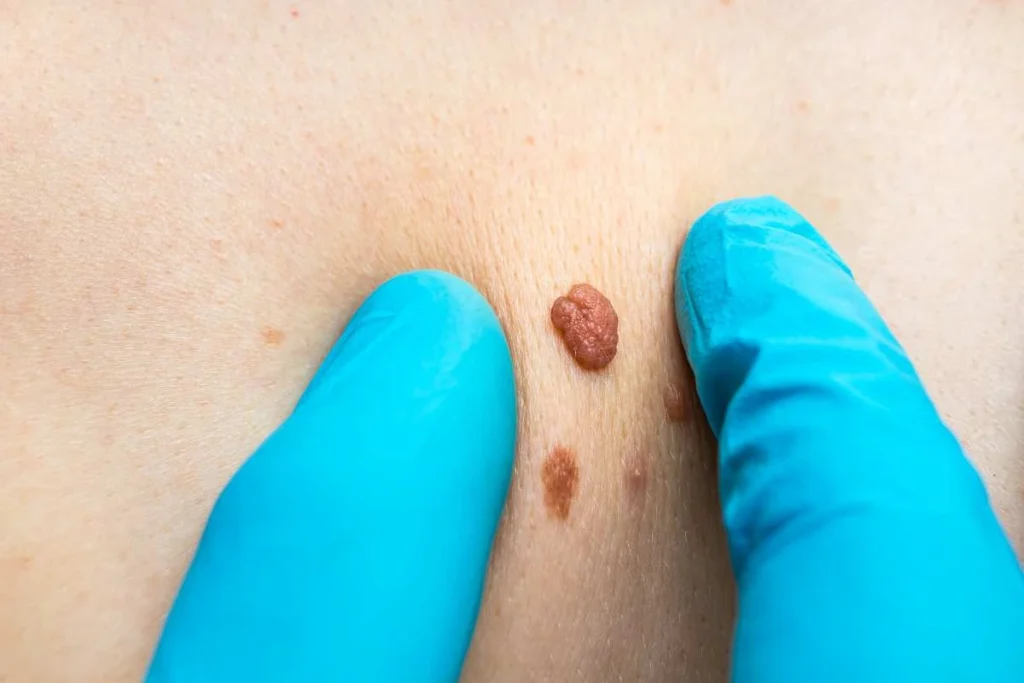 LA LIPO Cryopen Lesion Removal Prices Barnes