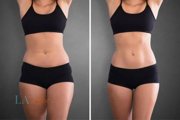 before and after results of non-surgical treatment to help a woman's body image and mental health Barnes