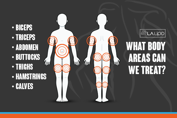 Diagram to show areas you can have LA-EMS Body Sculpting Treatment Barnes