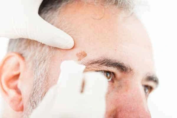 Age spots and elderly people Barnes what is the link?