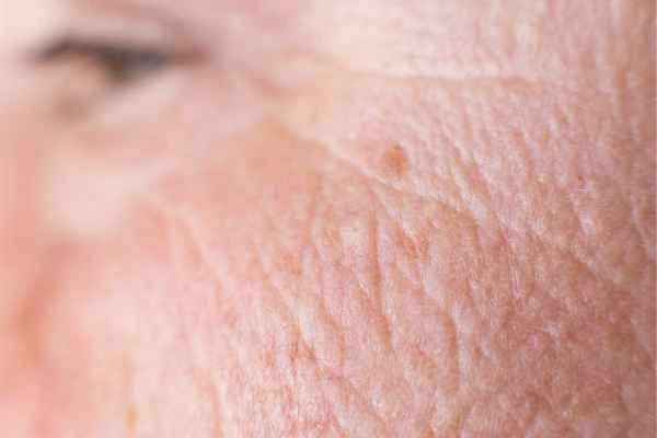 close up picture of a woman's face showing an age spot Barnes