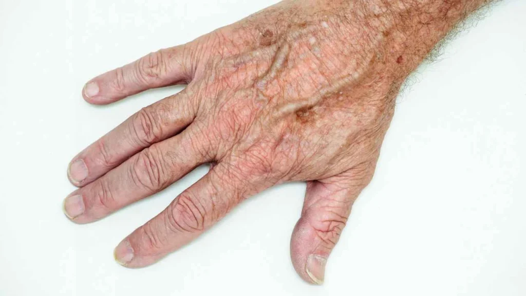 Male hand showing age spot Barnes
