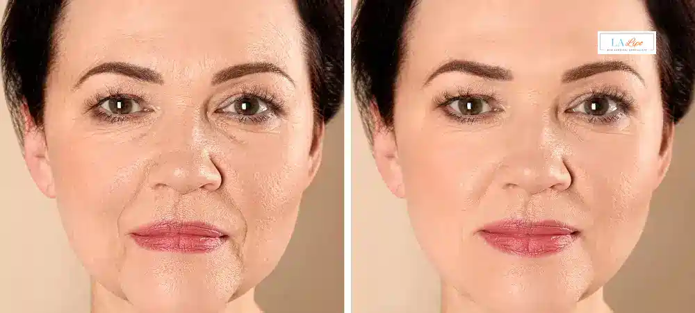 How Long Does It Take to See Results and How Long Do They Last Barnes?