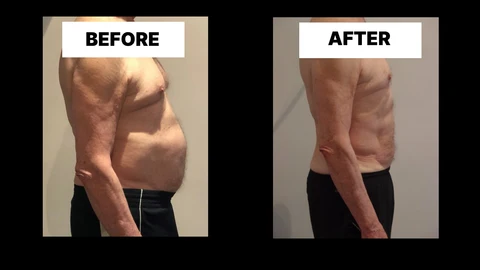 What Symptoms Can Diastasis Recti Cause in Men? Weak Core, Back Pain and Poor Posture Barnes